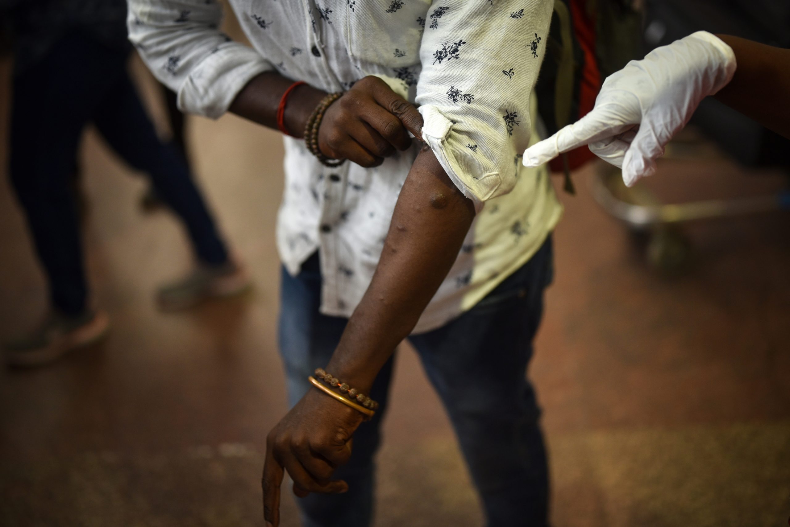 Portugal é o sexto país da Europa com mais casos de Monkeypox
