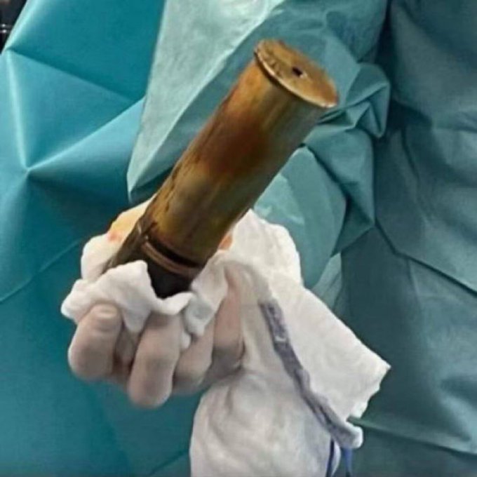 Hospital em Toulouse evacuado após homem dar entrada com engenho explosivo da I Guerra Mundial no corpo