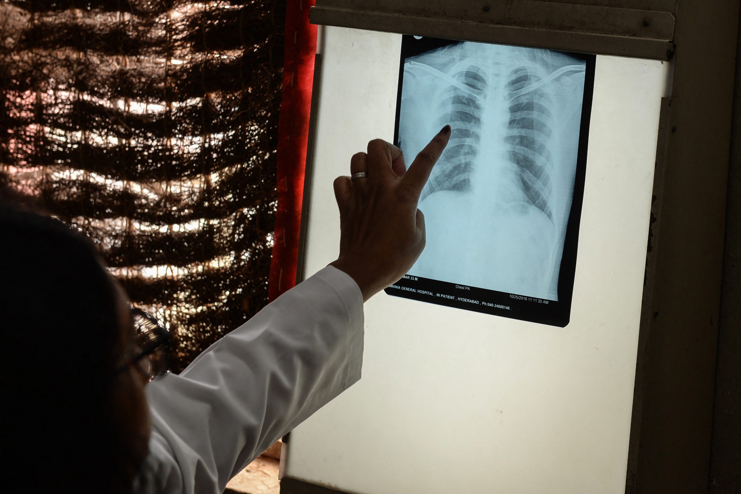 Covid-19: Região europeia da OMS registou mais 7.000 mortes por tuberculose na pandemia