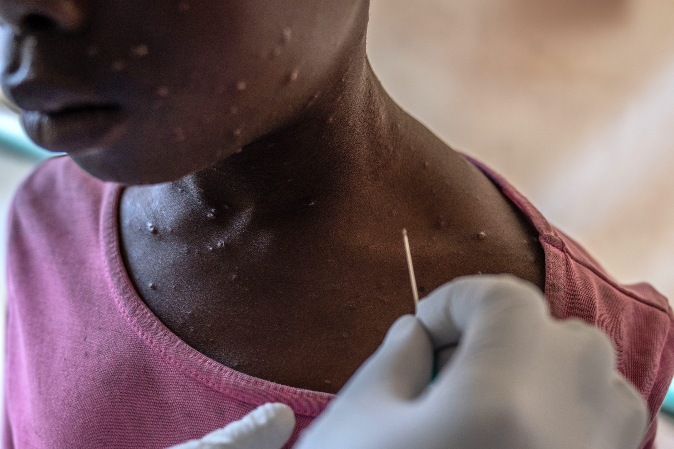 Mpox: detetados onze casos desde 1 de junho