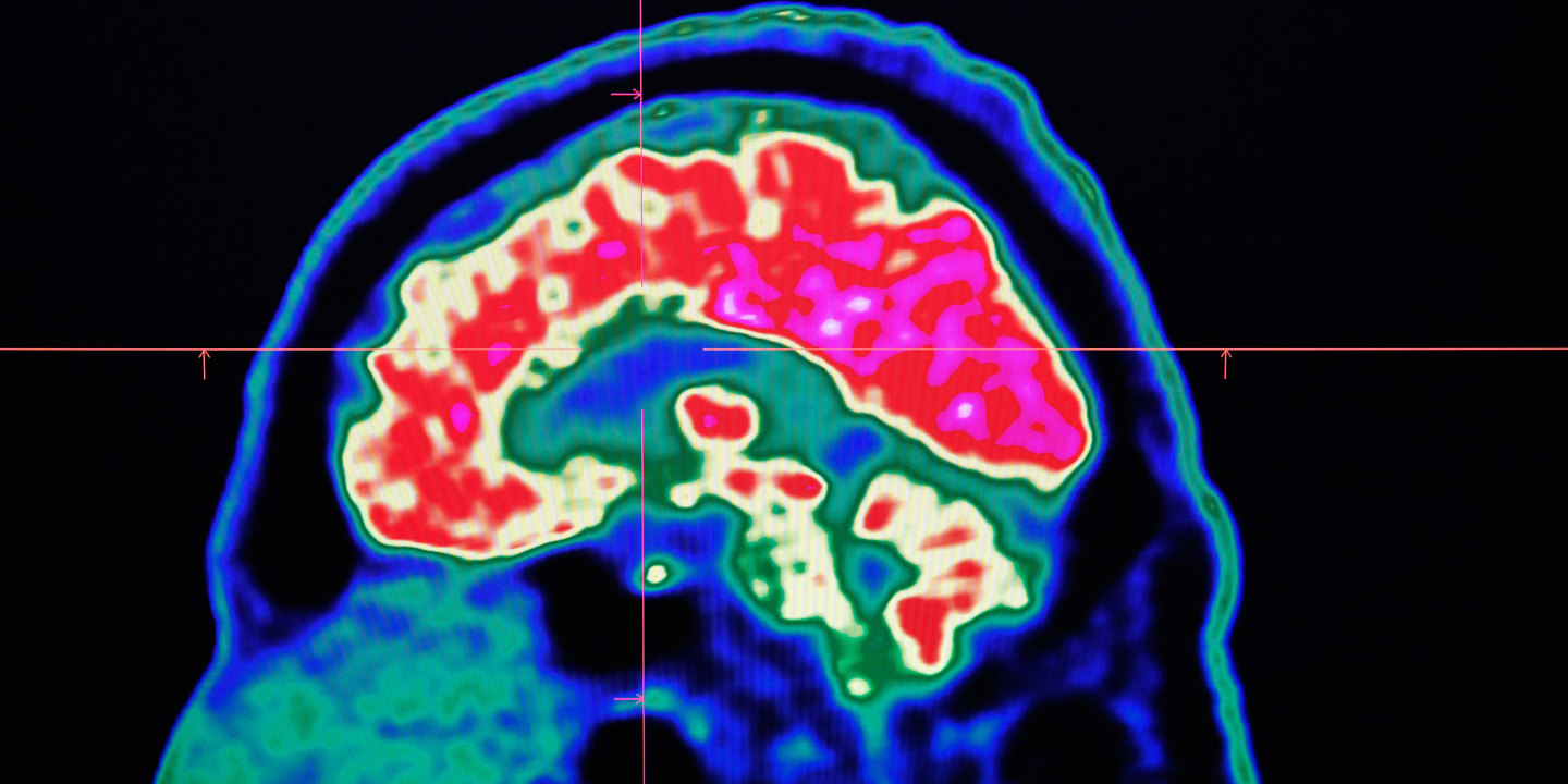 Parkinson. Novo medicamento trata momentos de bloqueio