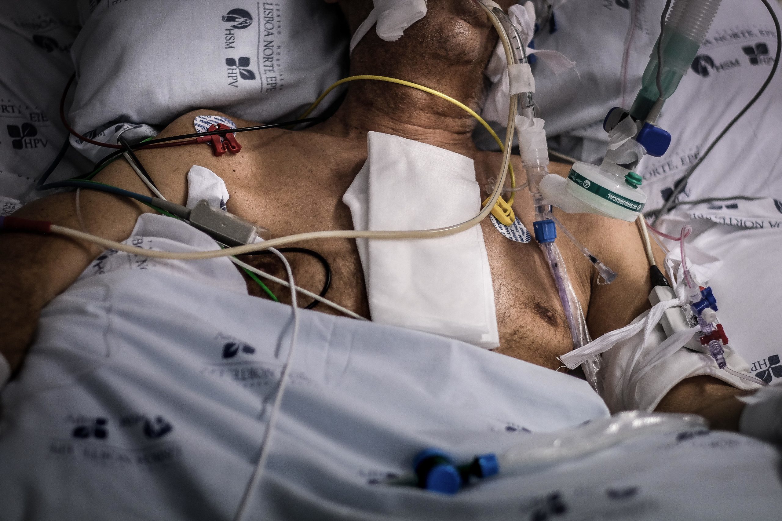 Covid-19: “Ainda está entubado, ventilado”. No Santa Maria permanece o primeiro infetado e corre-se contra o tempo