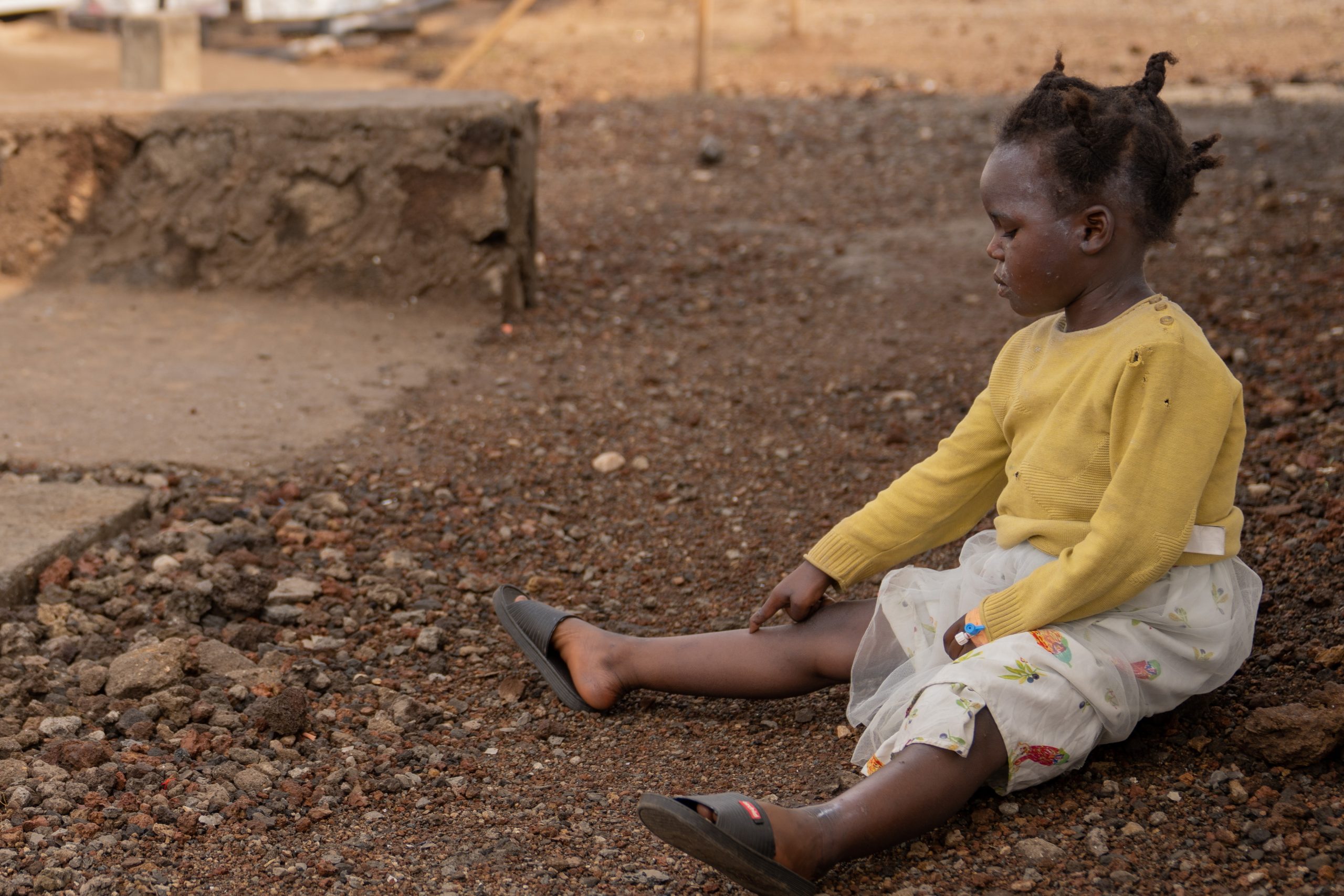 Moçambique eleva nível de alerta face à nova variante de ‘Mpox’