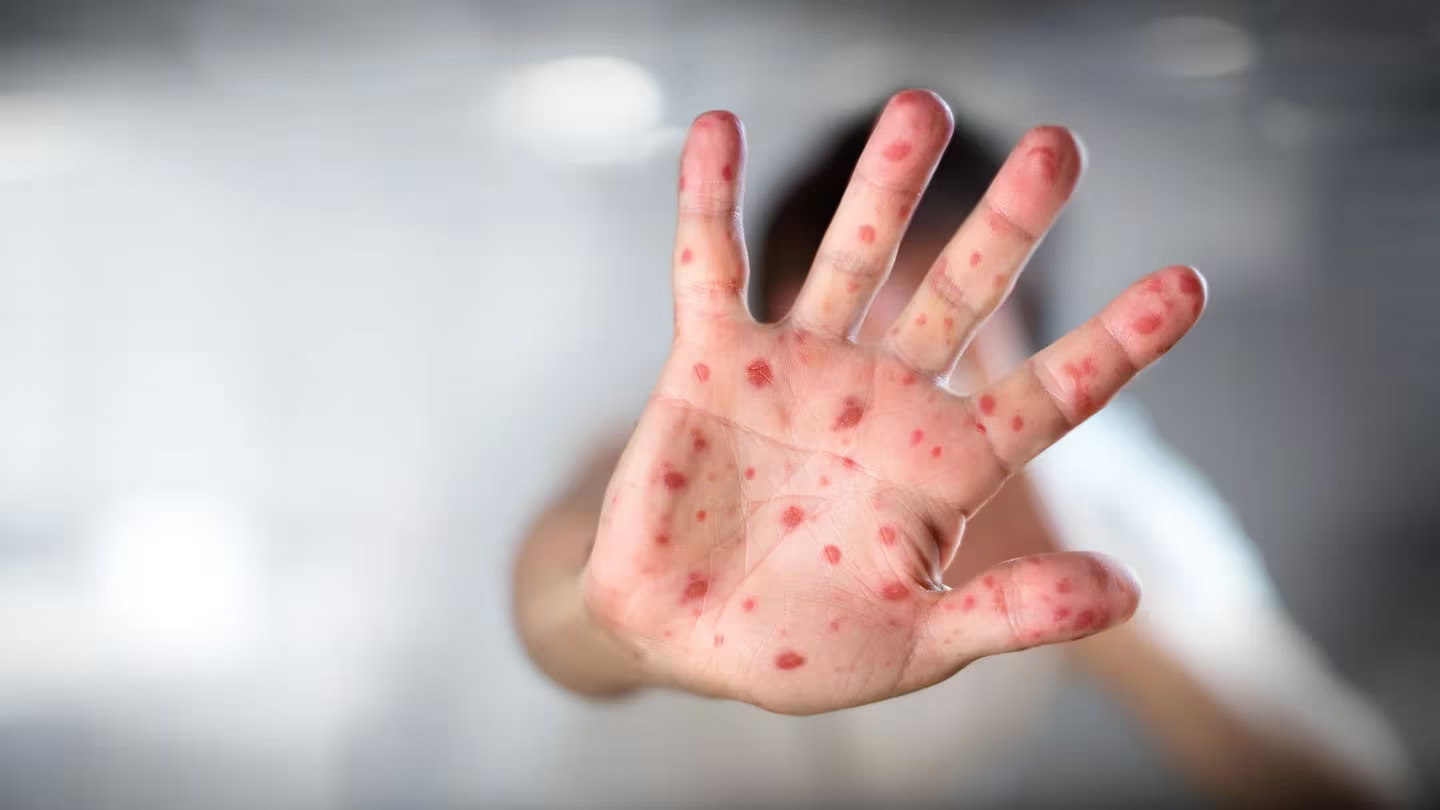 Surto de sarampo no Canadá. Começou na comunidade cristã de Menonitas e falta de vacinação foi o rastilho