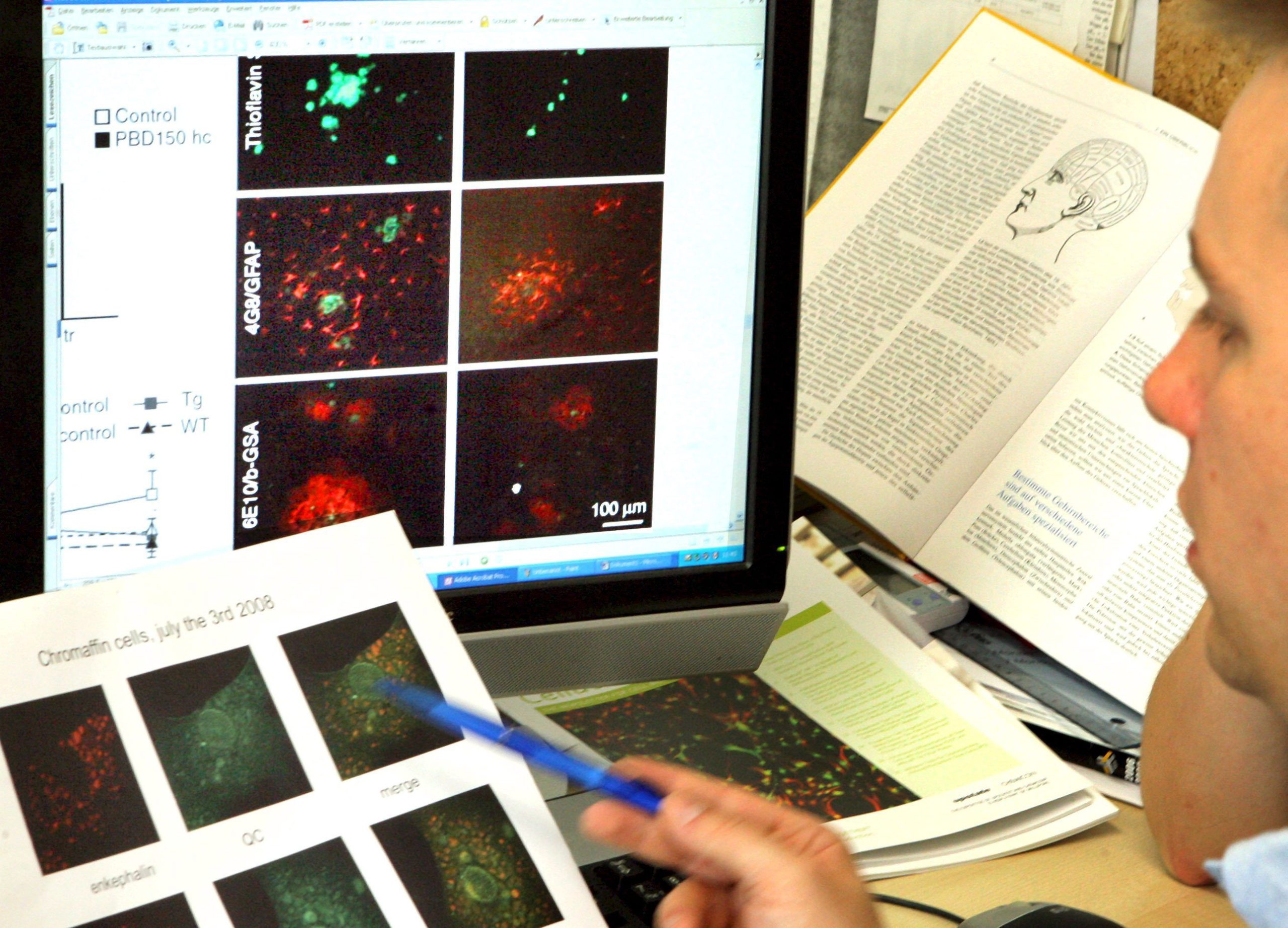 Sociedades científicas alertam para importância de teste genético na prevenção do cancro do ovário