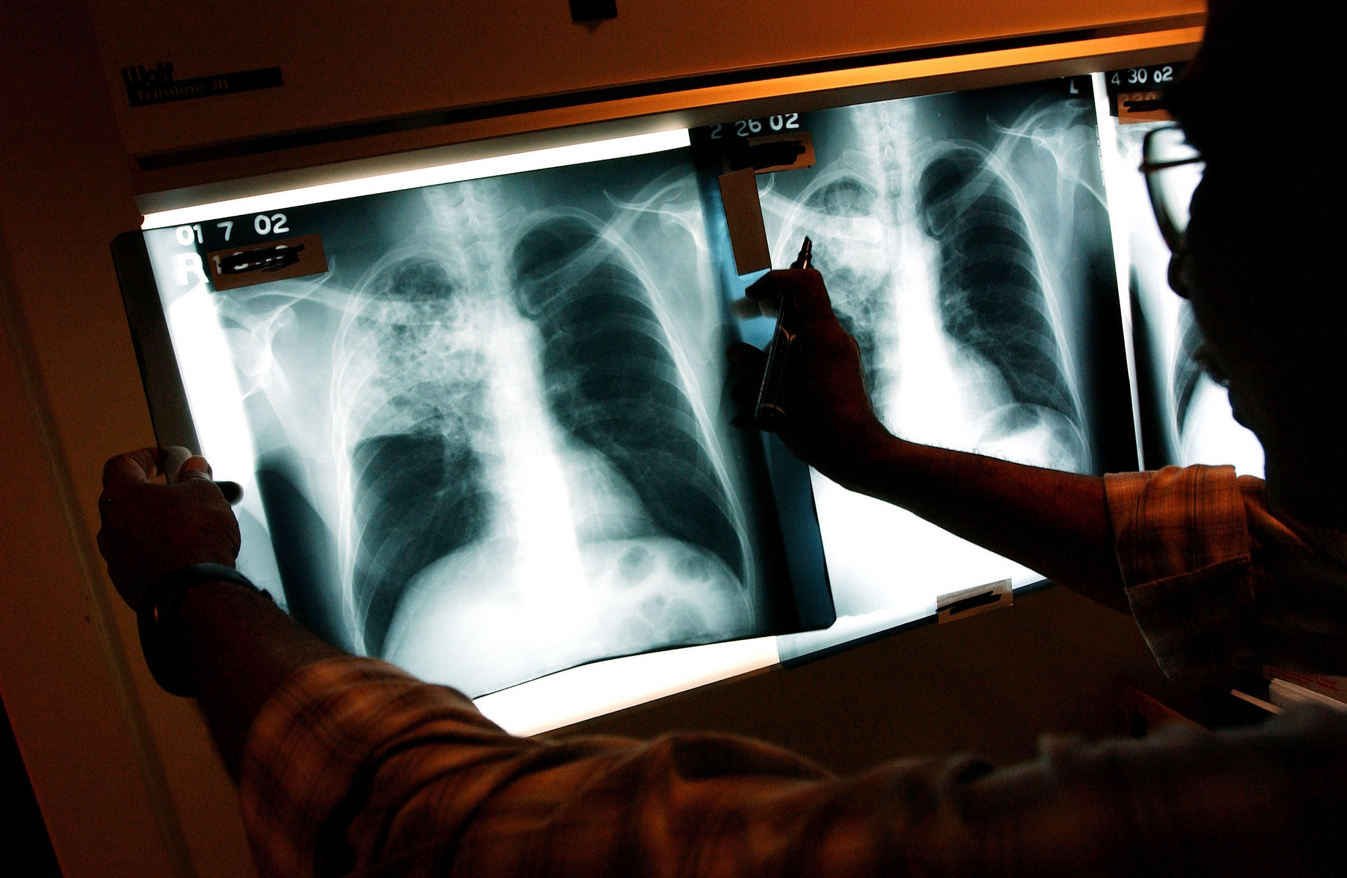Há menos casos de tuberculose em Portugal, mas leva-se ainda demasiado tempo a diagnosticar a doença