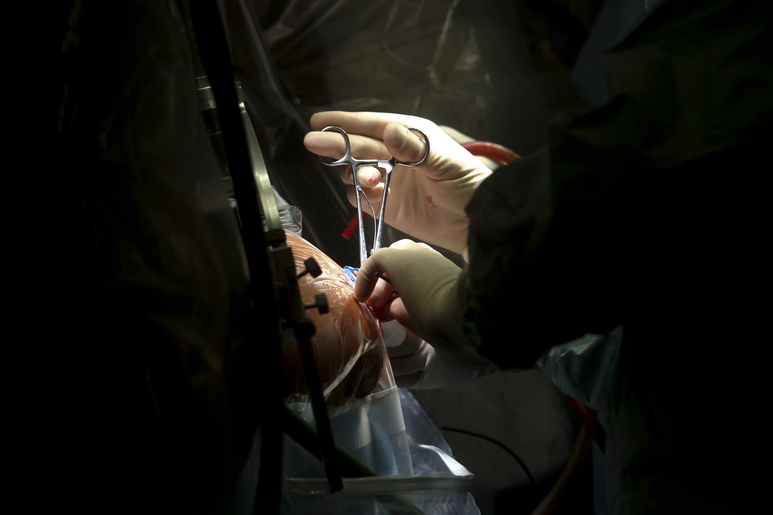 Cardiologia. Hospitais de Coimbra realizam intervenção pioneira em Portugal
