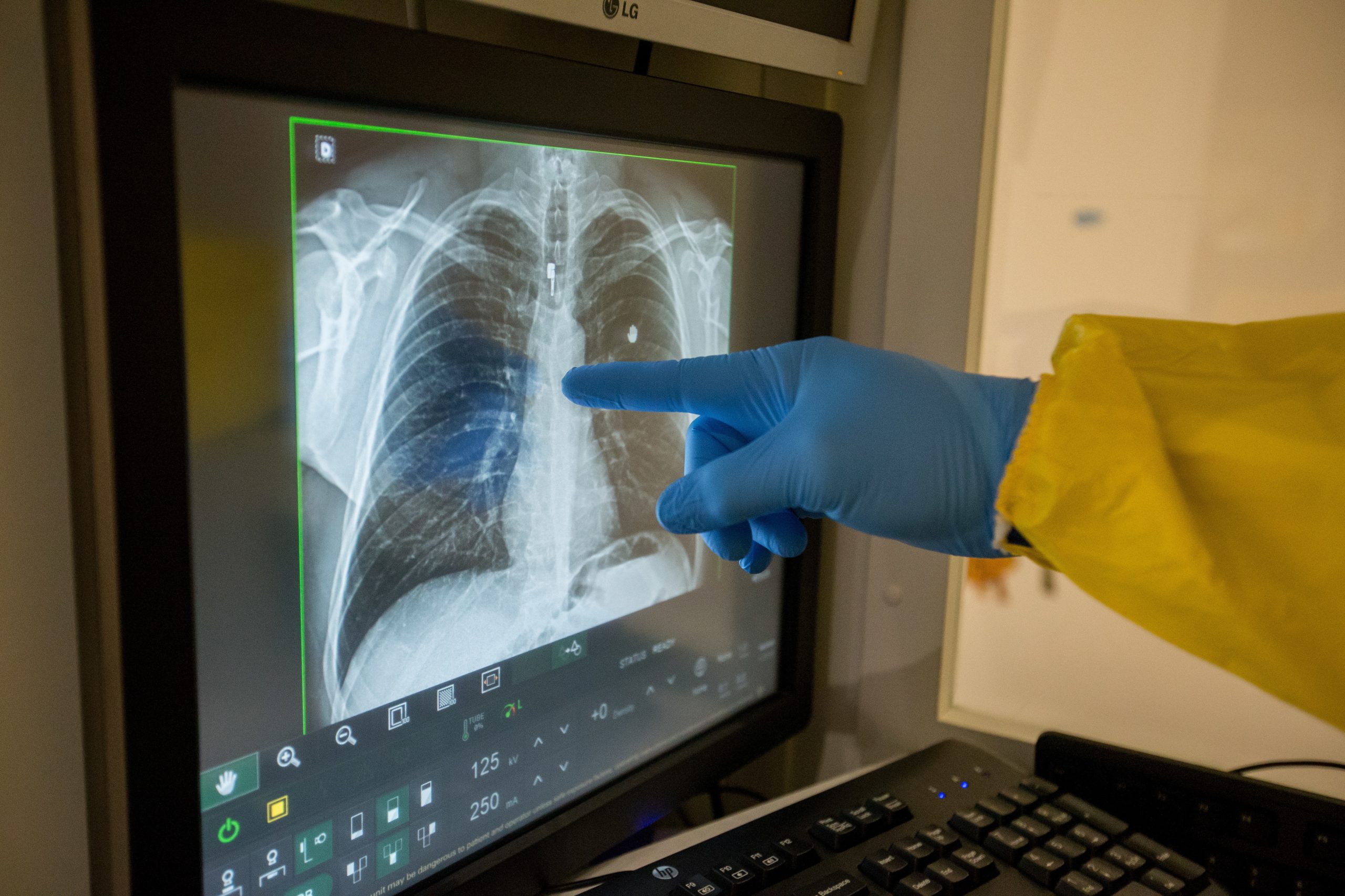 Taxa de incidência da tuberculose atingiu em 2018 novo máximo desde 2010