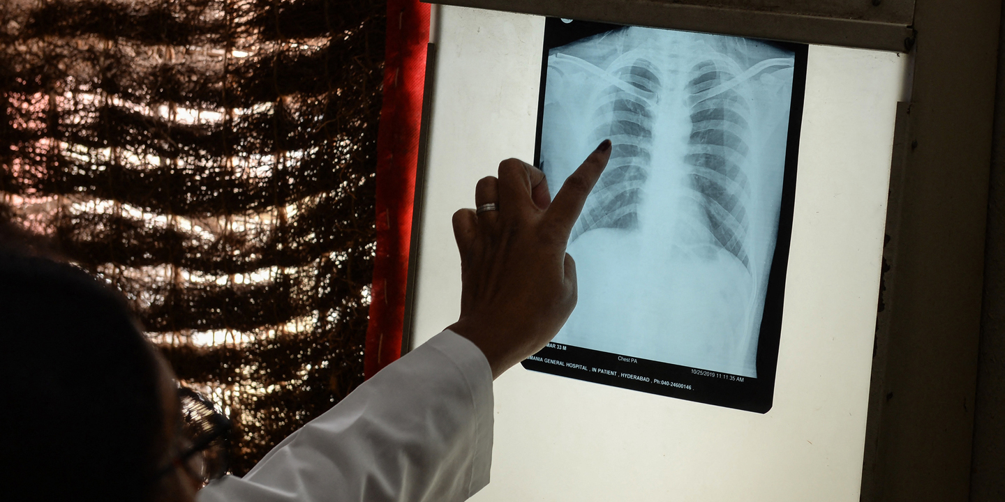 Tuberculose: Casos notificados baixaram, tempo de diagnóstico subiu