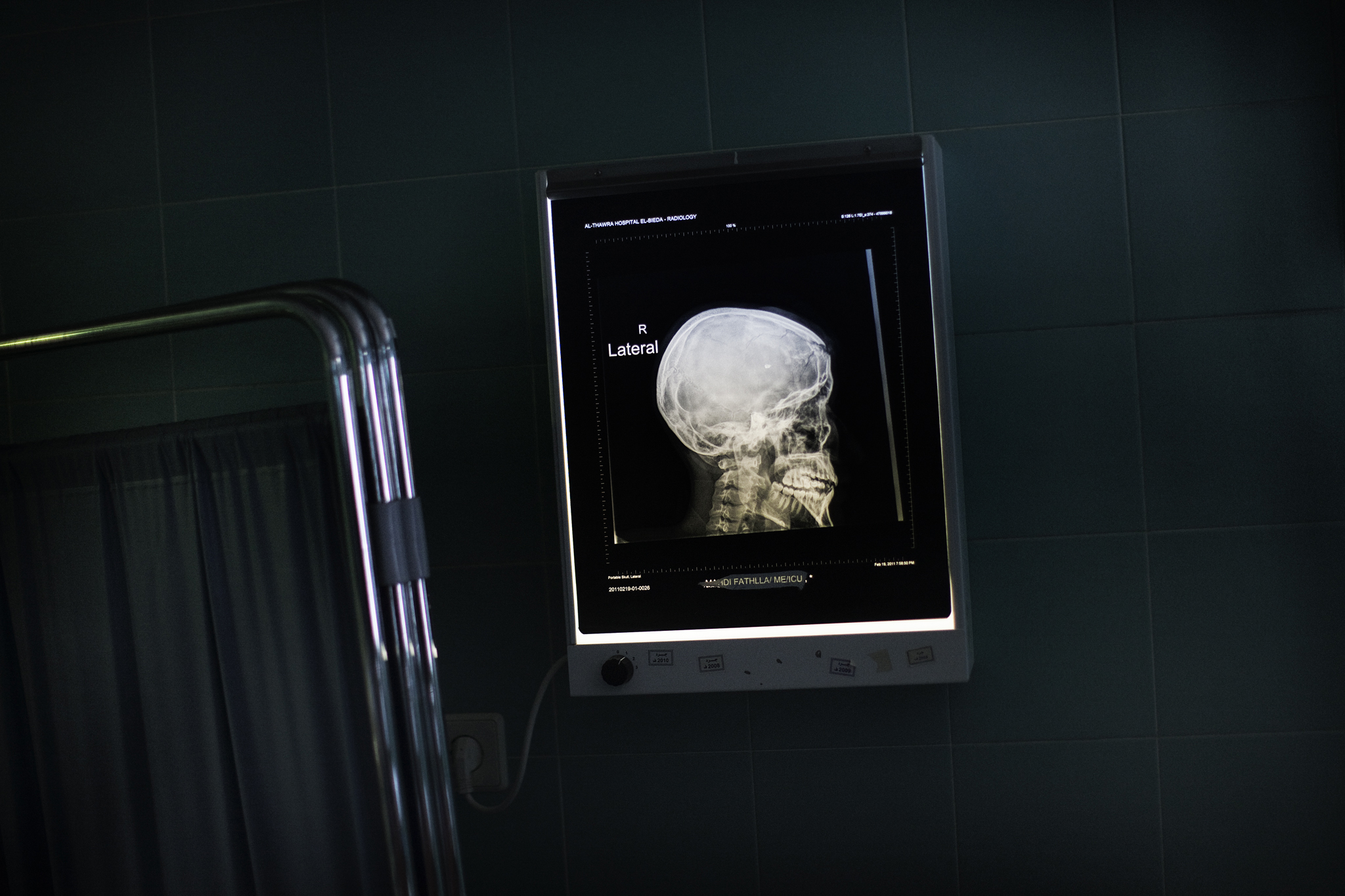 Traumatismo crânio encefálico grave mata 600 pessoas por ano em Portugal