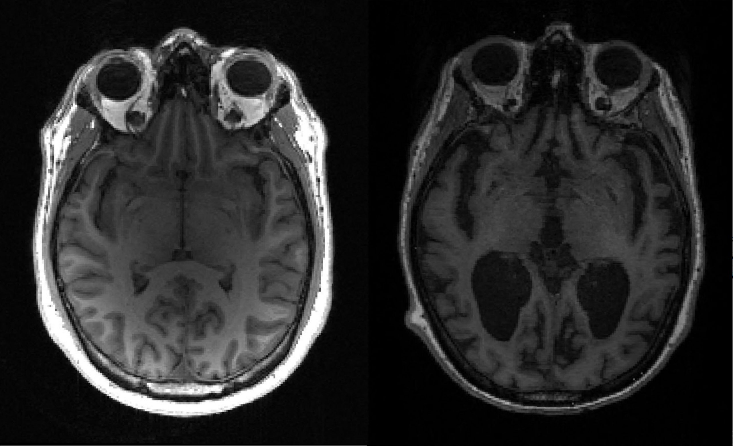 Projeto português para combater Alzheimer premiado internacionalmente. Tecnologia pode “atrasar ou inibir” a doença