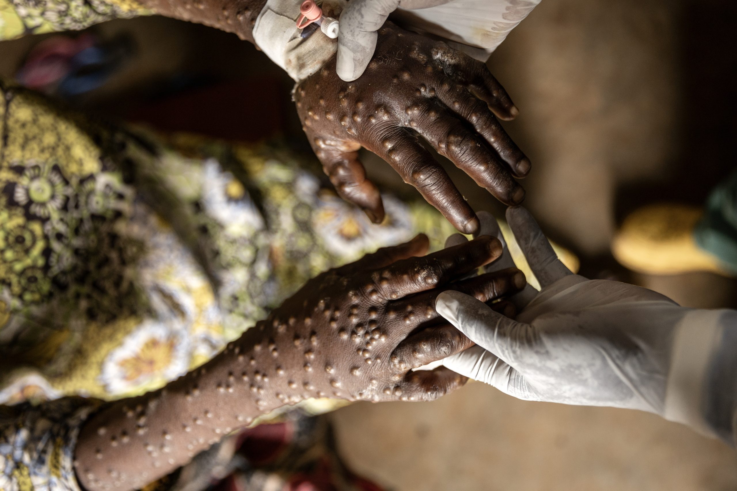 Mpox: Portugal é o sexto na Europa com mais casos registados