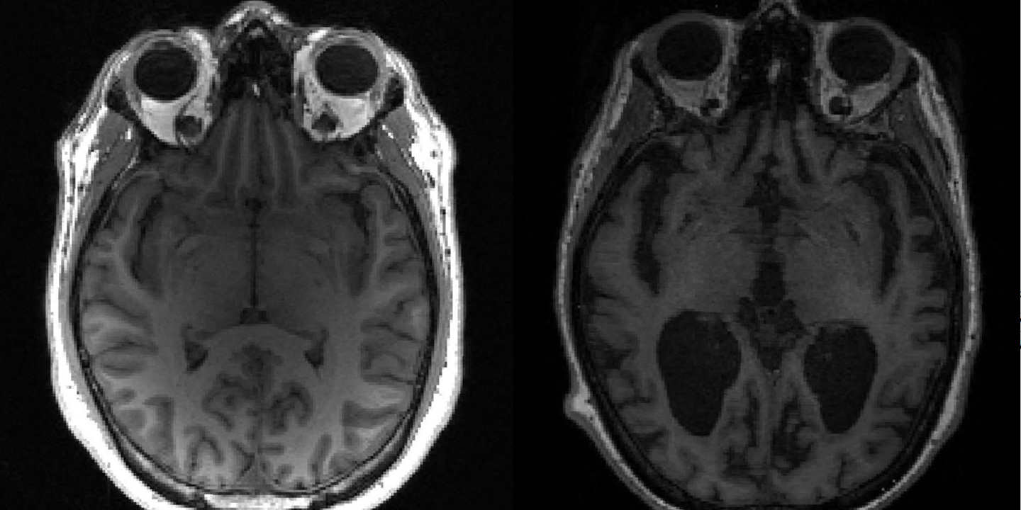 Empresa portuguesa recebe 1,5 milhões de euros para investigar tratamento para Alzheimer