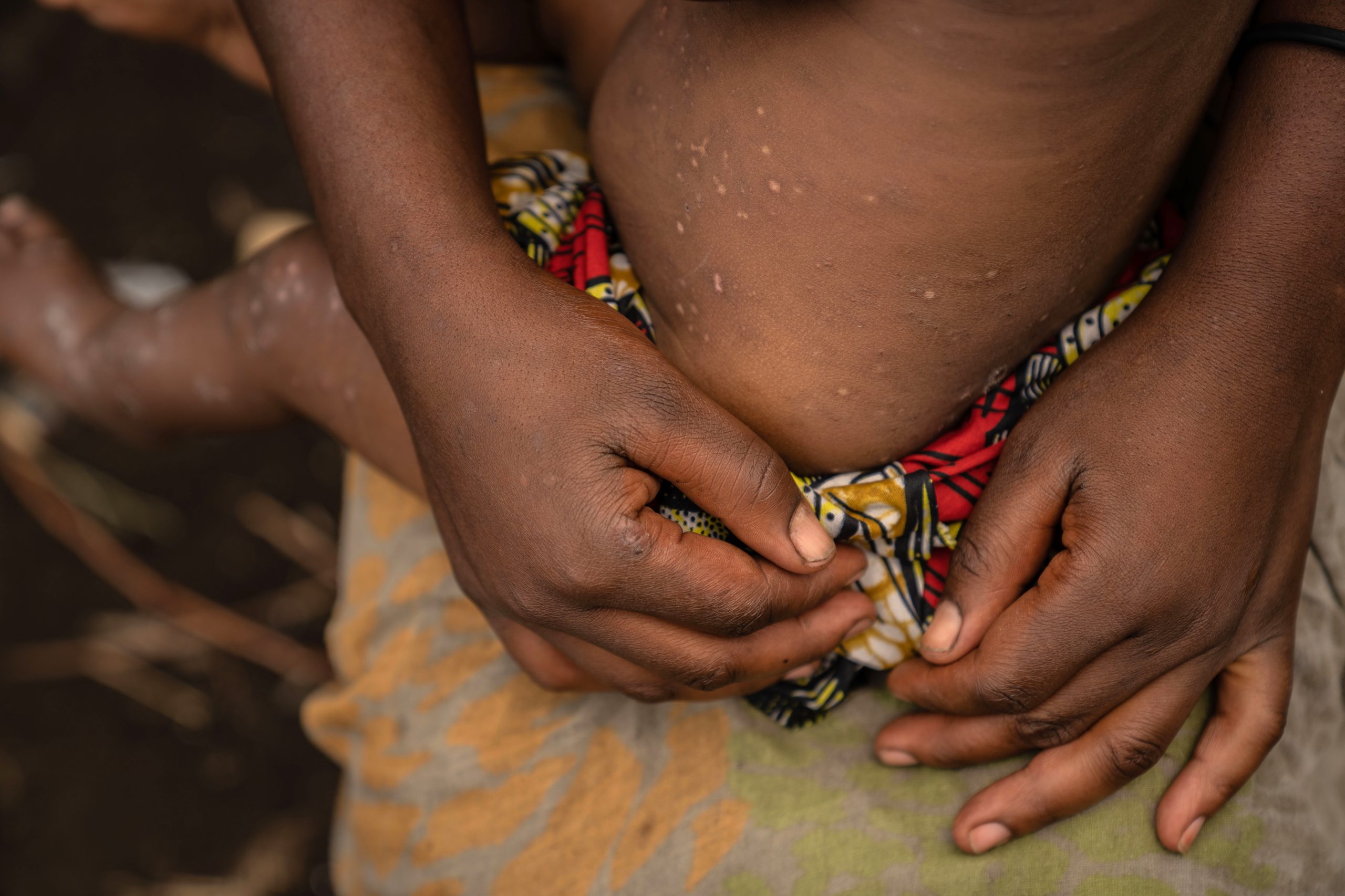 Mpox já matou 866 pessoas em África desde o início do ano
