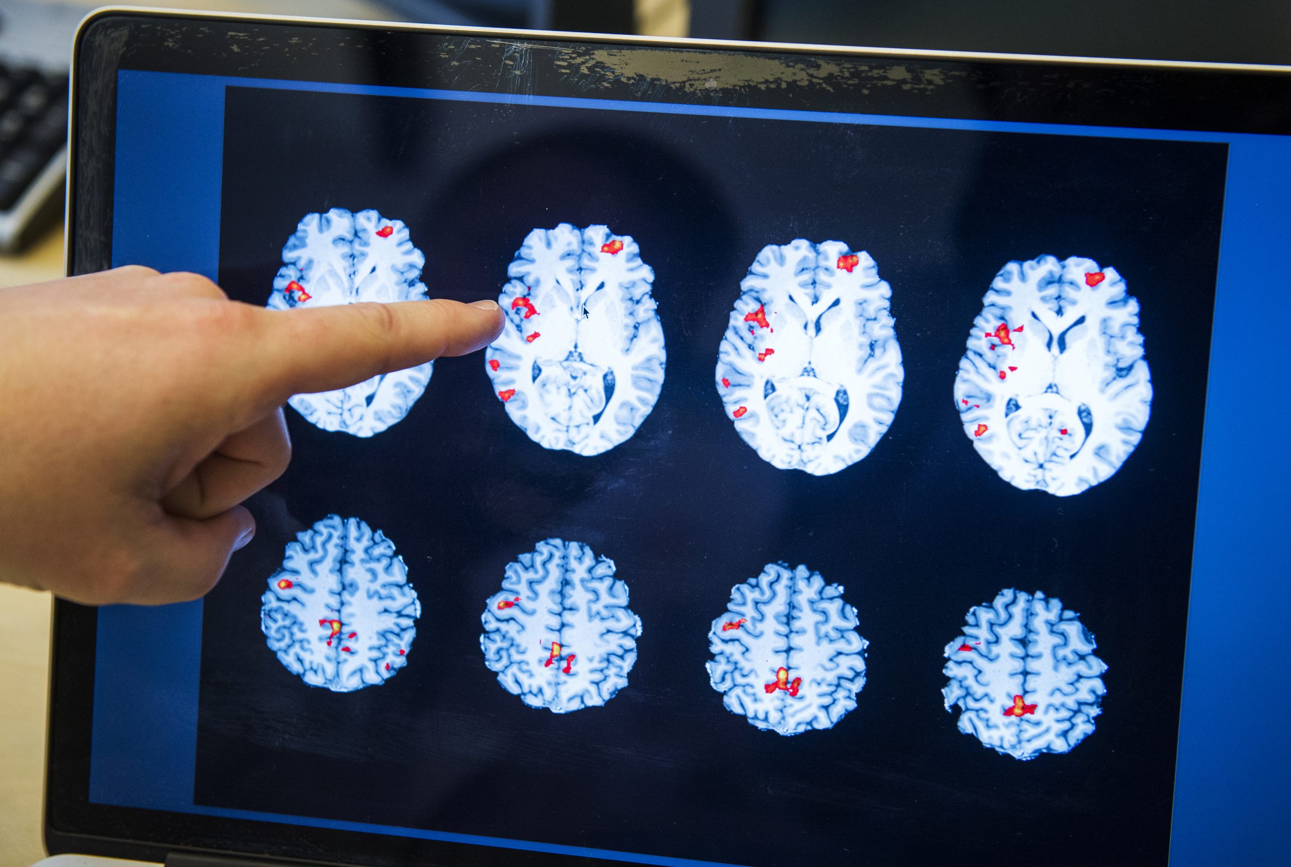 Uma startup que ajuda a identificar Alzheimer e Parkinson