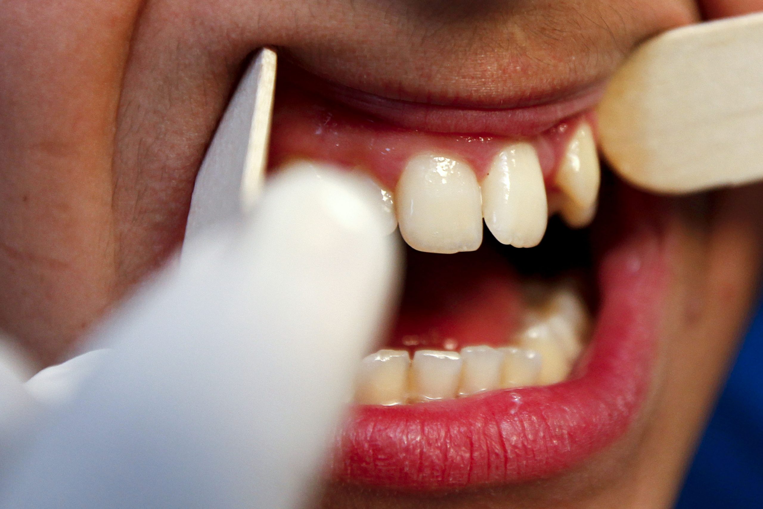 PS quer mexer no IVA sobre ostras, próteses dentárias e medidores da diabetes