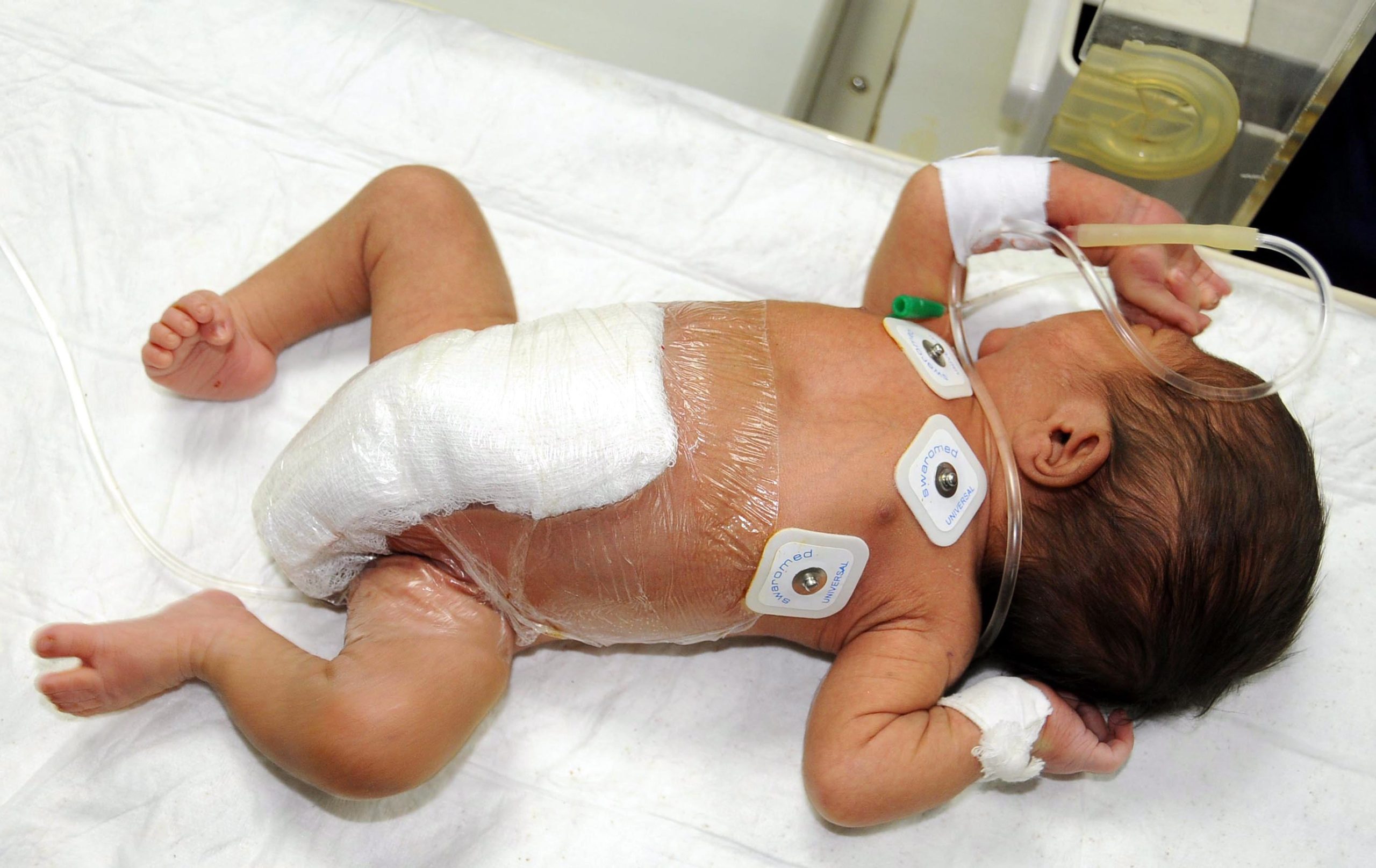Amnistia Internacional alerta para cirurgias desnecessárias em bebés interssexo