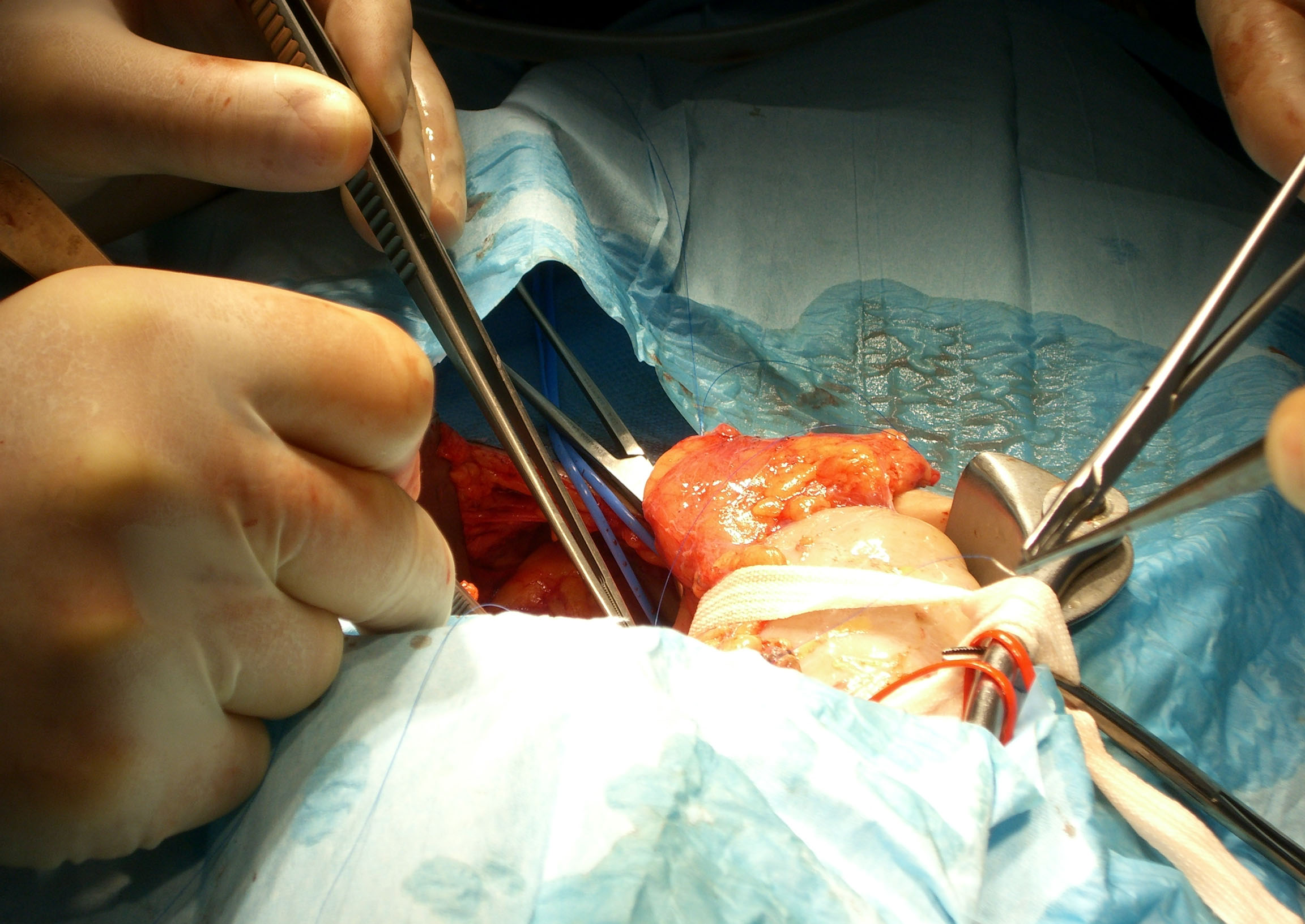 Rim de porco continua a funcionar em humano mais de um mês depois do transplante
