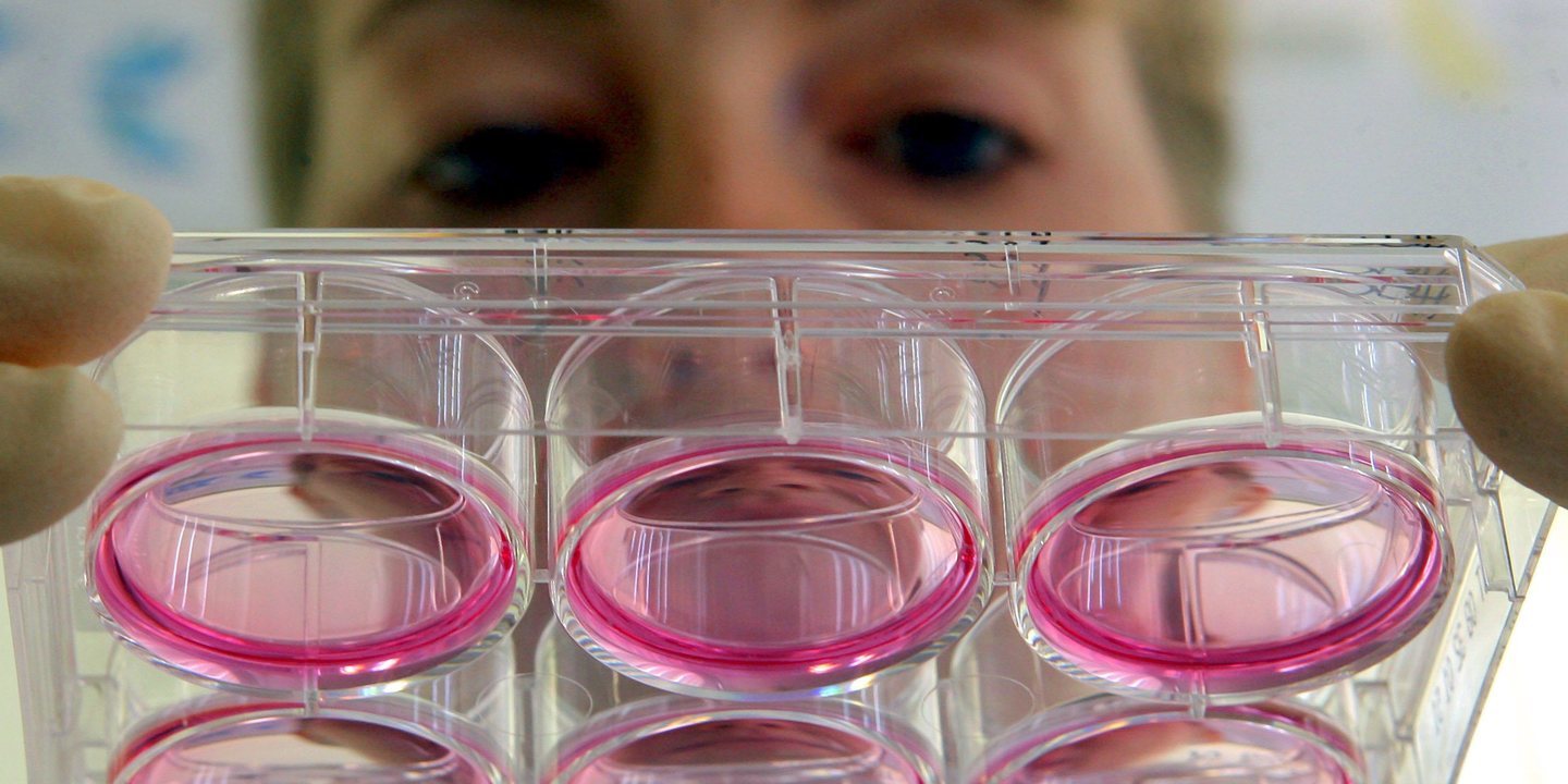 Alzheimer: investigadores estabelecem perfis bioquímicos em estádios iniciais da doença