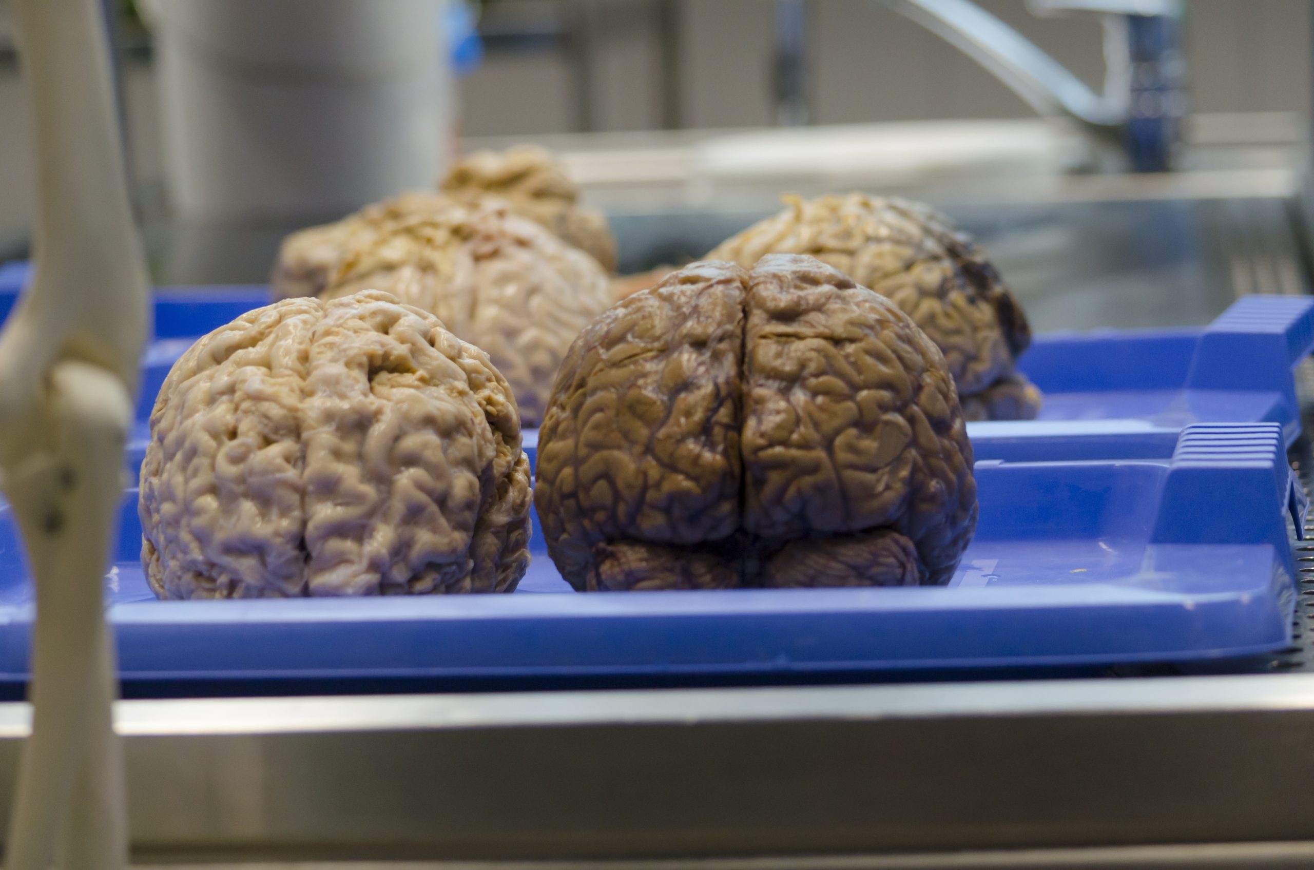 Novo método de estimulação profunda do cérebro pode ajudar a tratar Parkinson