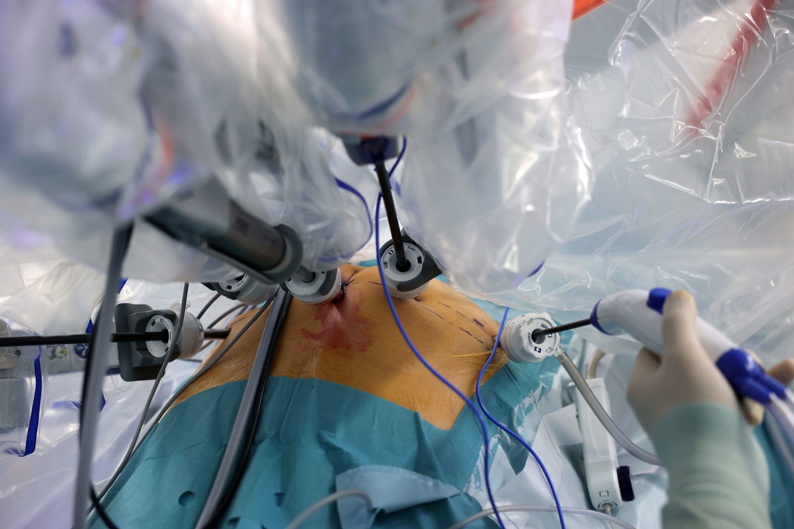 Urologia: Hospital de Coimbra realiza centésima cirurgia robótica