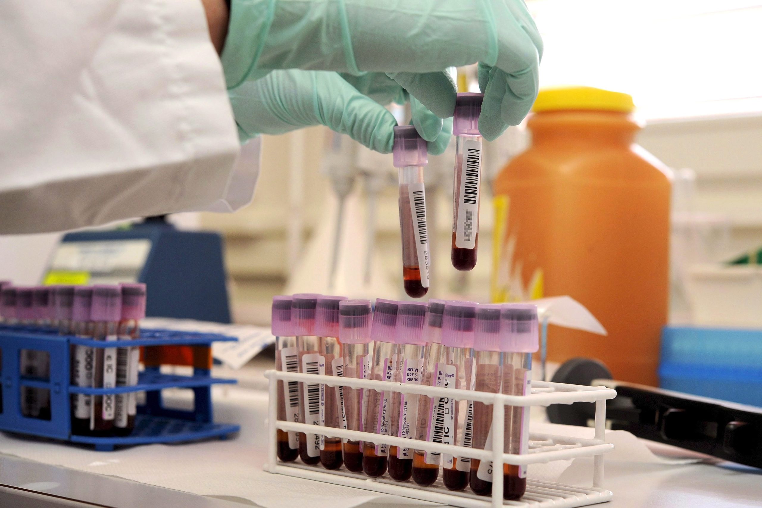 Detetar leucemia: Análise ao sangue pode substituir amostra de medula óssea