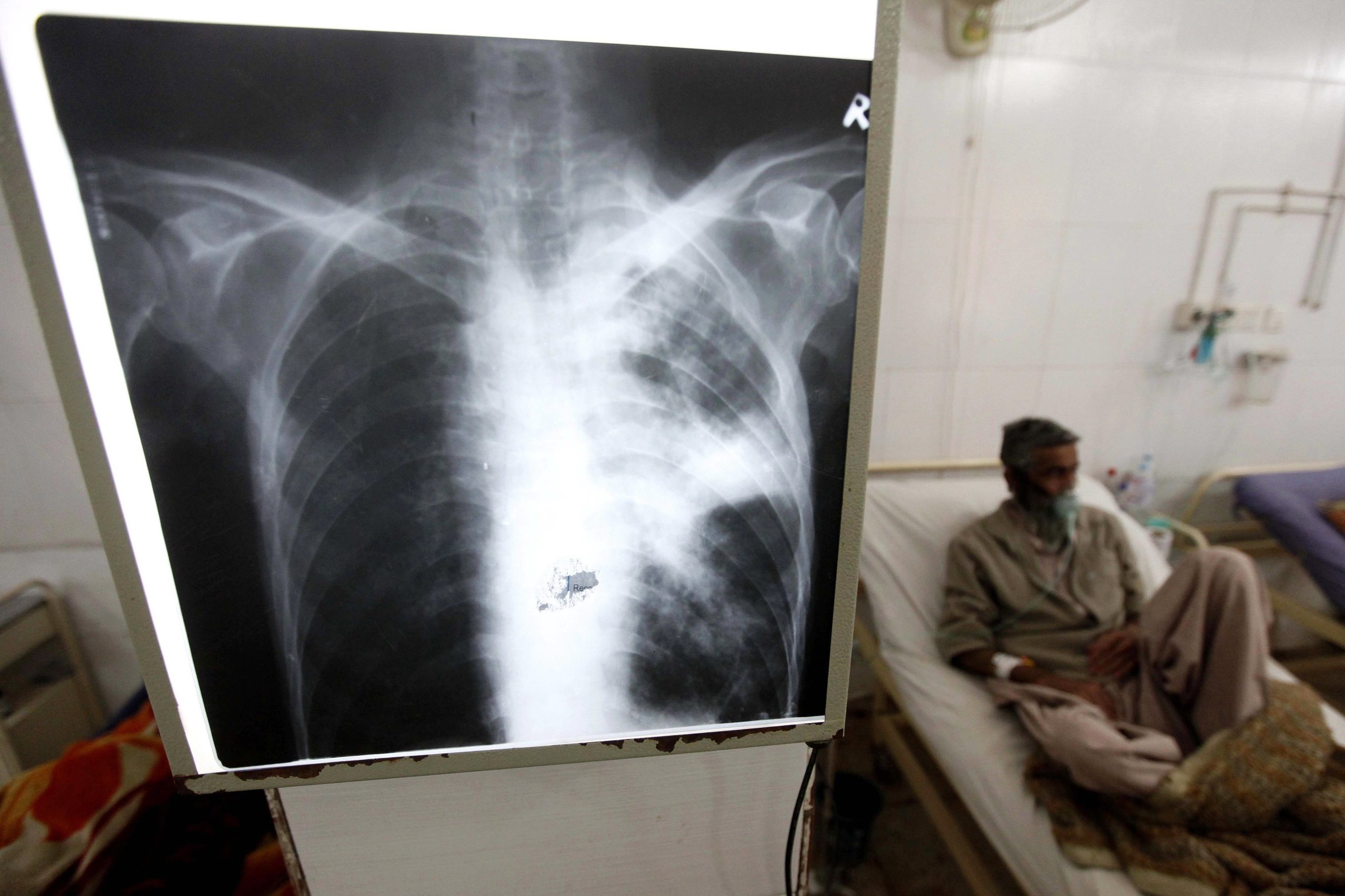 Associação alerta que deteção da tuberculose está mais difícil devido à pandemia